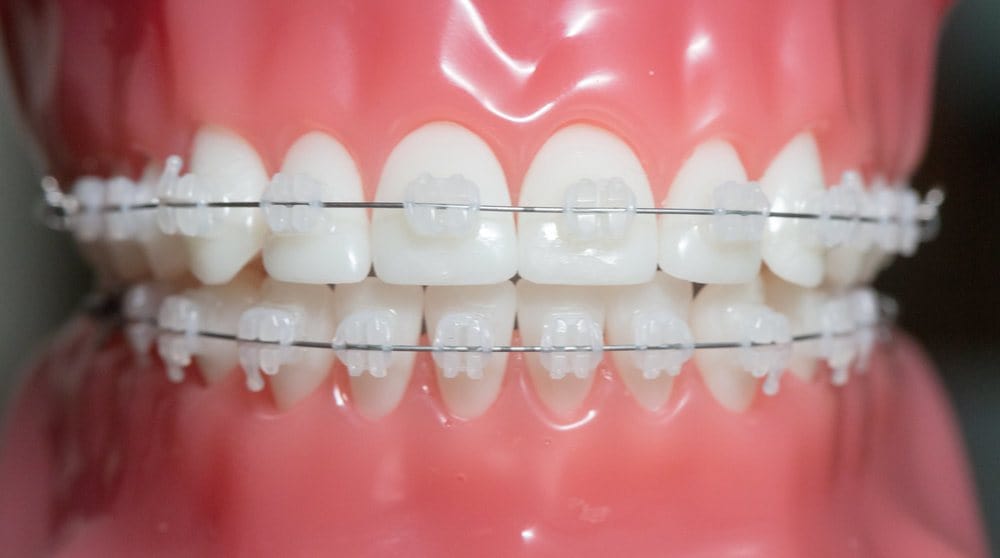 Mod&egrave;les de bo&icirc;tiers fixes orthodontiques