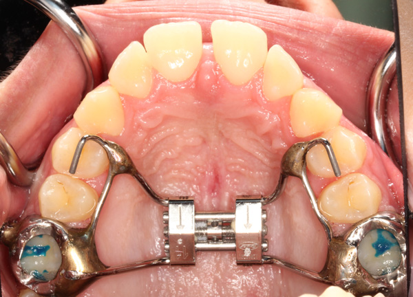 Palatal expansion appliance in the mouth - interior view showing the expander attached to the molars