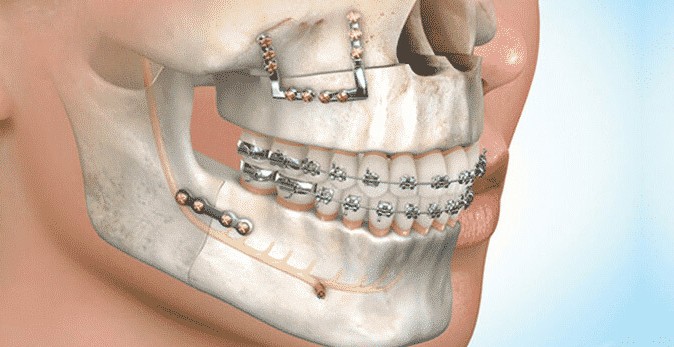 Bimaxillary surgery for sleep apnea
