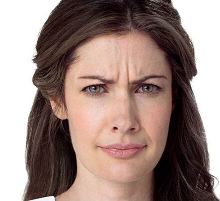 Avant injection Botox - rides du front visibles