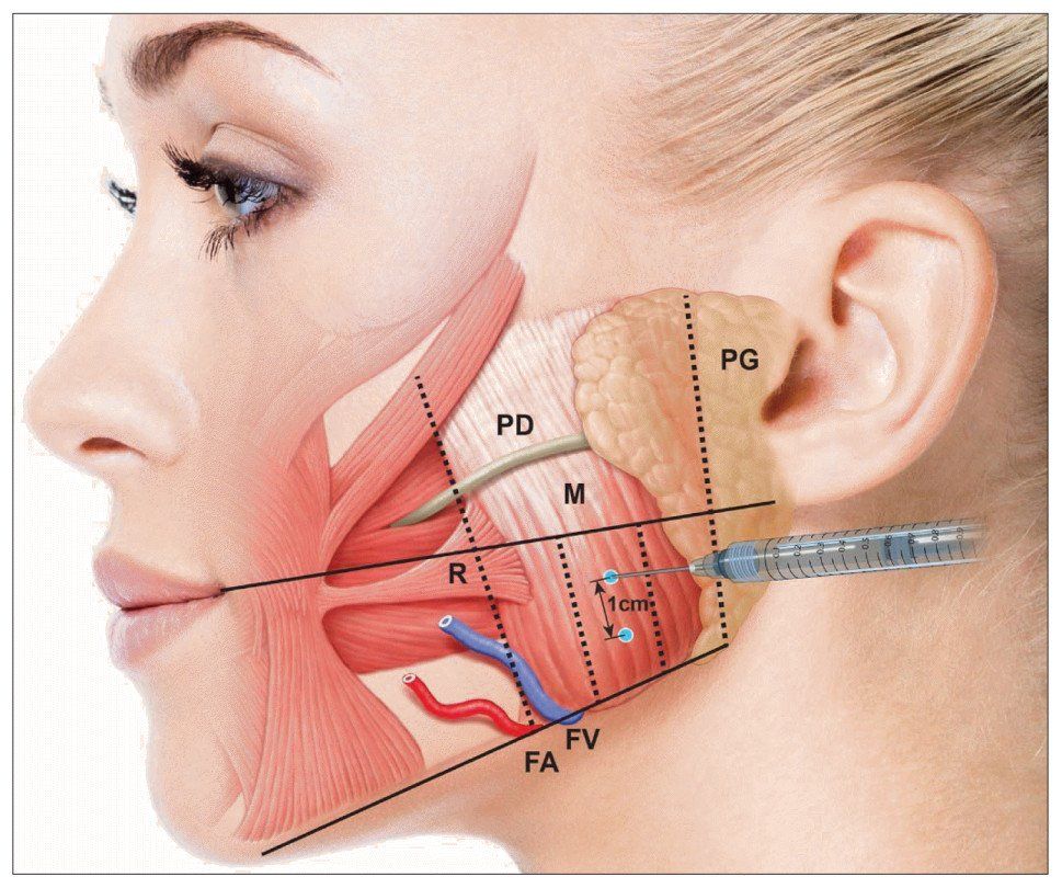 Anatomie du masseter et injection de Botox pour bruxisme