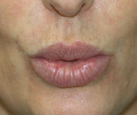 Apr&egrave;s Botox rides du fumeur