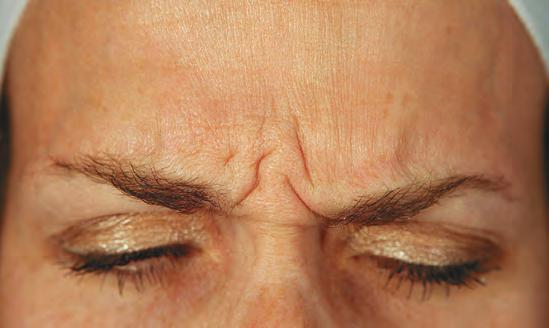 Avant Botox rides du lion