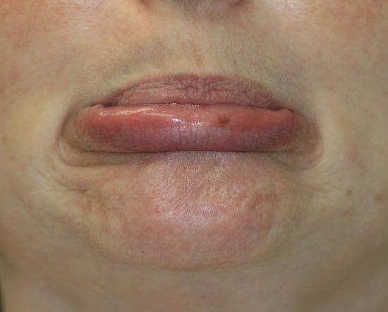 Apr&egrave;s Botox menton peau d'orange