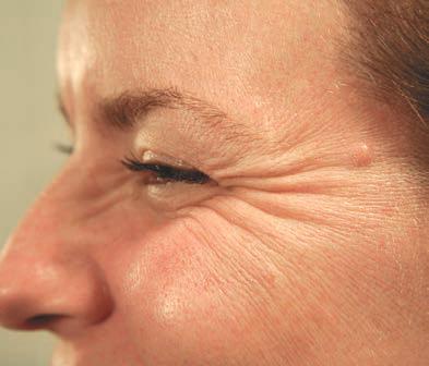 Avant Botox pattes d'oie