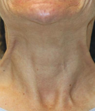 Apr&egrave;s Botox bandes platysmales