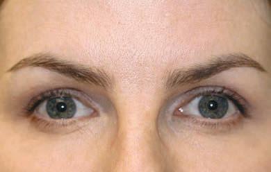 Apr&egrave;s Botox relev&eacute; du sourcil