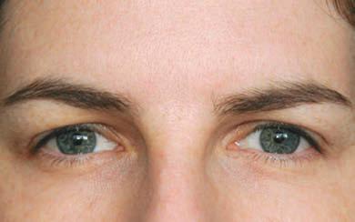 Avant Botox relev&eacute; du sourcil