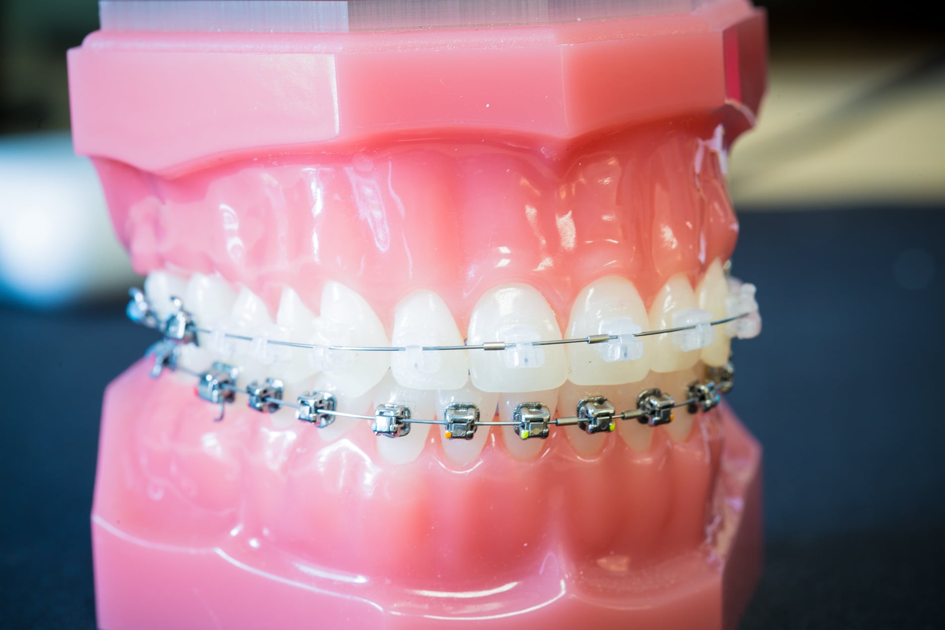Fixed orthodontic brackets