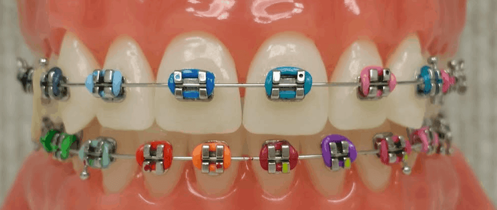 Broches métalliques orthodontiques