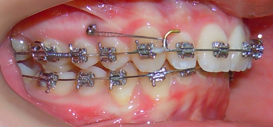 Orthodontic TAD mini-screw inserted in the gum for skeletal anchorage