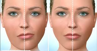 Facial asymmetry surgery