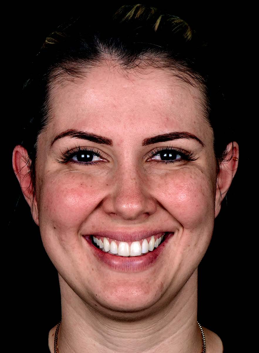 Gummy smile - After treatment