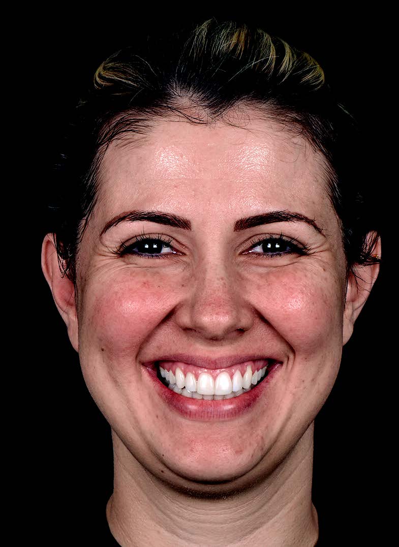 Gummy smile - Before treatment