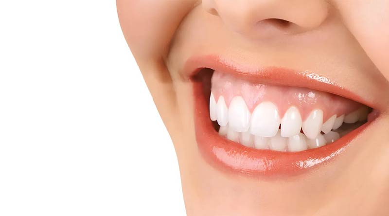 Gummy smile - excessive gum exposure