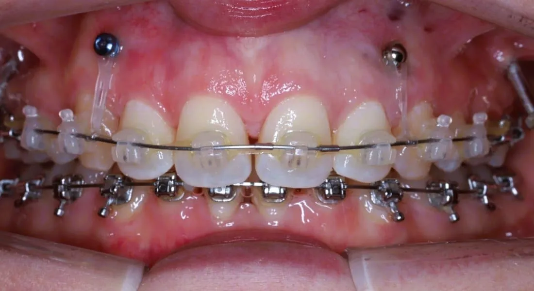 Orthodontic treatment of gummy smile