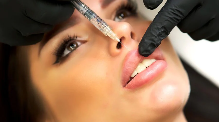 Dermal filler lip injection - precise technique with syringe