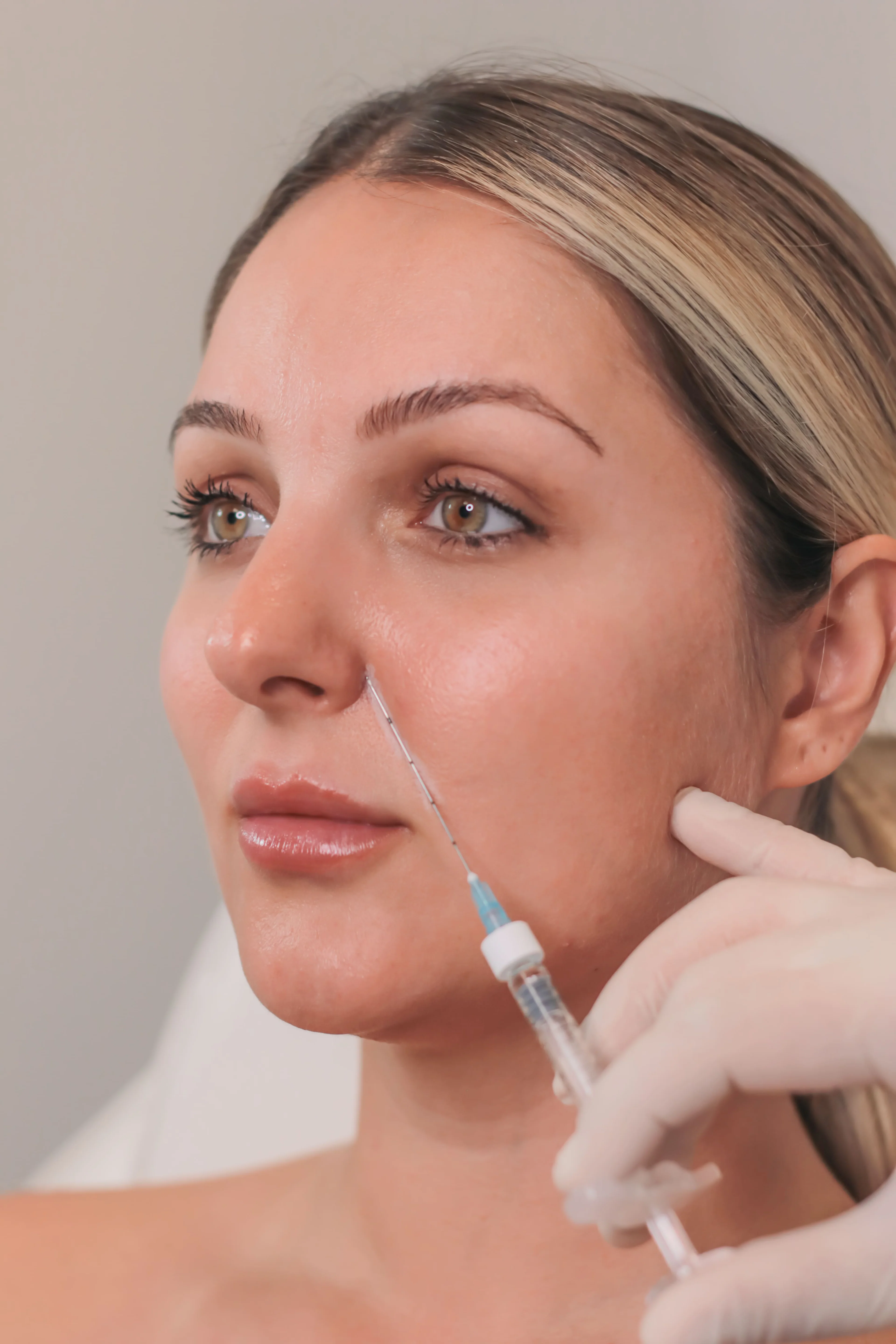 Nasolabial fold filler injection