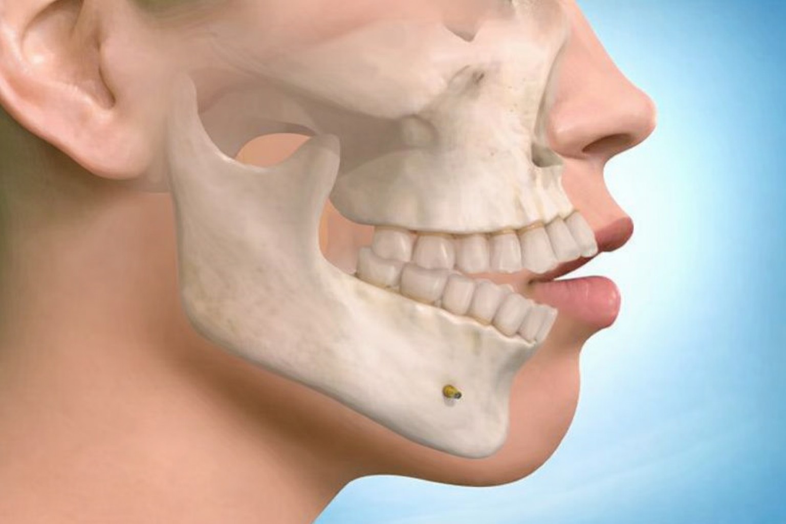Anterior open bite surgery