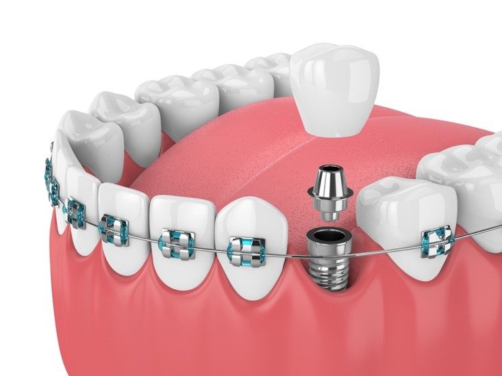 Orthodontics and dental implants