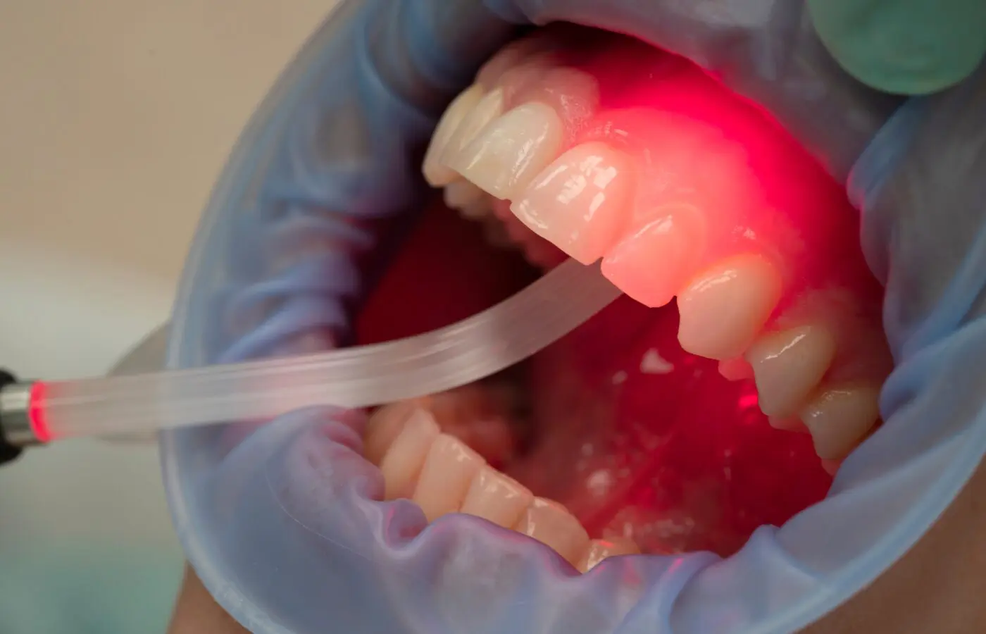 Photobiomodulation dentaire &mdash; lumi&egrave;re LED pour acc&eacute;l&eacute;rer le traitement orthodontique