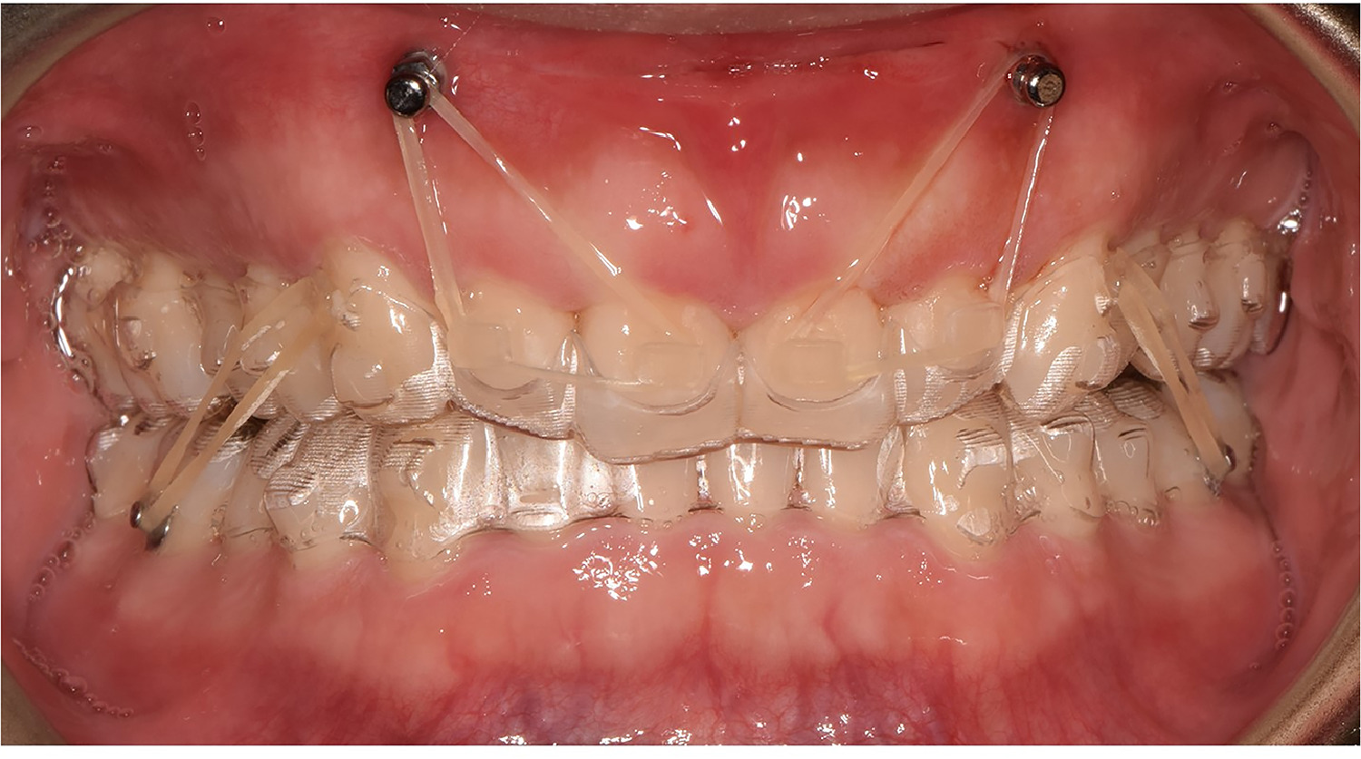 TAD mini-screws with clear aligners for complex cases