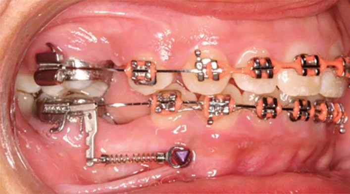 TAD mini-screws for dental asymmetries and protraction