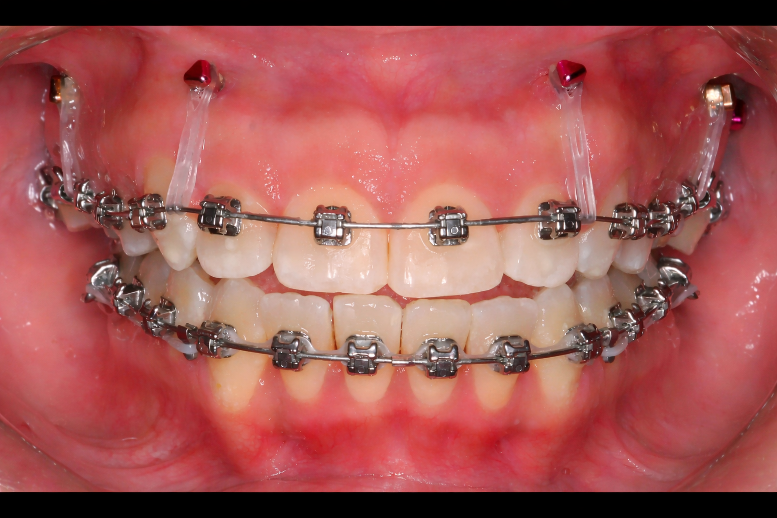 TAD mini-screws for anterior open bites with braces