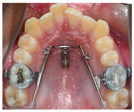 TAD mini-screws for molar distalization