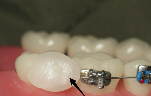 Applying orthodontic wax on a bracket to relieve irritation