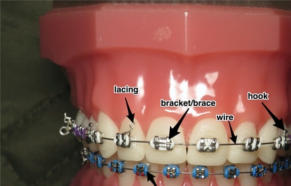Components of an orthodontic appliance - brackets, wire, ligatures and elastics