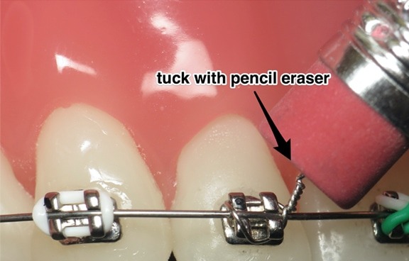 Using a pencil eraser to reposition an orthodontic wire