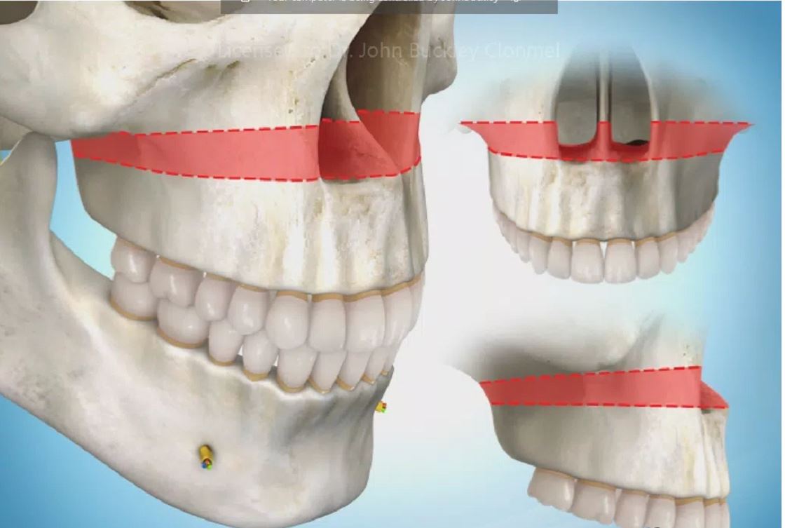 Vertical maxillary excess surgery